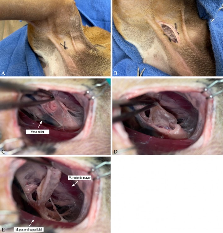 <p><strong>Ganglios axilares</strong>. Los ganglios axilares se localizan entre el músculo redondo mayor (lateral), el recto del tórax (medial) y el borde dorsal del pectoral profundo (ventral). El abordaje es paralelo al miembro torácico y a las líneas de tensión, justo caudal a la parte descendente del músculo pectoral superficial, en la hendidura que forma con la parte transversa de este músculo (Fig. <strong>4A</strong> y <strong>B</strong>). El ganglio suele encontrarse en una acumulación de grasa periganglionar justo caudal a la vena axilar, después de diseccionar digitalmente en el tejido conectivo de la axila (Fig. <strong>4C</strong>). El ganglio se encuentra más adherido a la parte torácica (próxima al músculo pectoral profundo) que a la parte del miembro torácico (Figs. <strong>4D</strong> y <strong>E</strong>).</p>