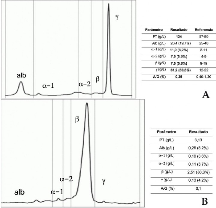 <p>Electroforesis de proteínas en suero y orina. (<strong>A</strong>) Electroforesis capilar de proteínas séricas en la que se observa un marcado aumento en la fracción de las gammaglobulinas. (<strong>B</strong>) Electroforesis de proteínas urinarias sobre gel de agarosa en el que se demuestra un pico marcado en la fracción de las betaglobulinas. PT=proteínas totales; Alb= albúmina; α-1= alfa-1 globulinas; α-2= alfa-2 globulinas; β= beta globulinas; γ = gamma globulinas; A/G= ratio albúmina/globulina.</p>
