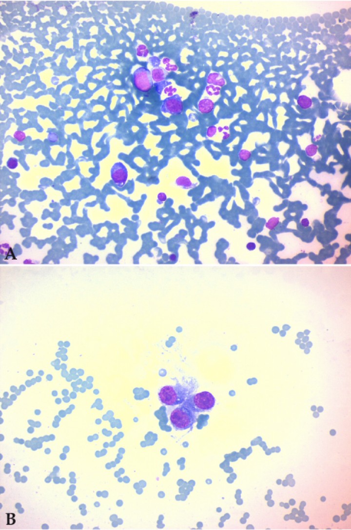<p>Punción de médula ósea. (<strong>A</strong>) Se observan dos células plasmacitoides atípicas en el centro de la imagen, de citoplasma basófilo con leve halo claro perinuclear. (<strong>B</strong>) Elementos celulares atípicos de morfología ambigua. La textura de la cromatina y la morfología nuclear señalan compatibilidad con fenotipo plasmacítico (x400, tinción H/E).</p>