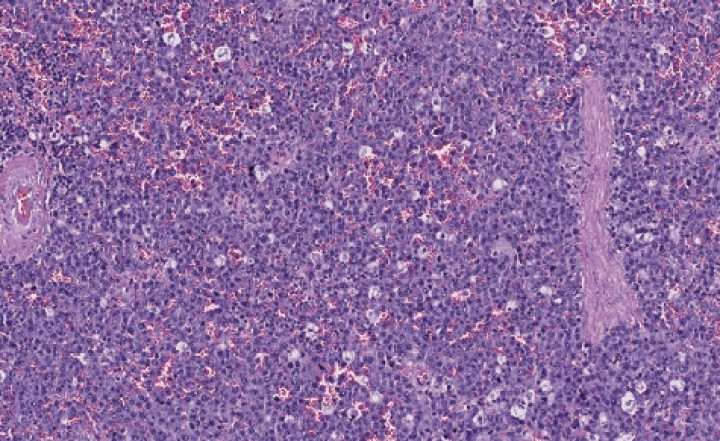 <p>Bazo. Infiltración masiva de la pulpa blanca y pulpa roja por la población neoplásica (x200, tinción H/E).</p>