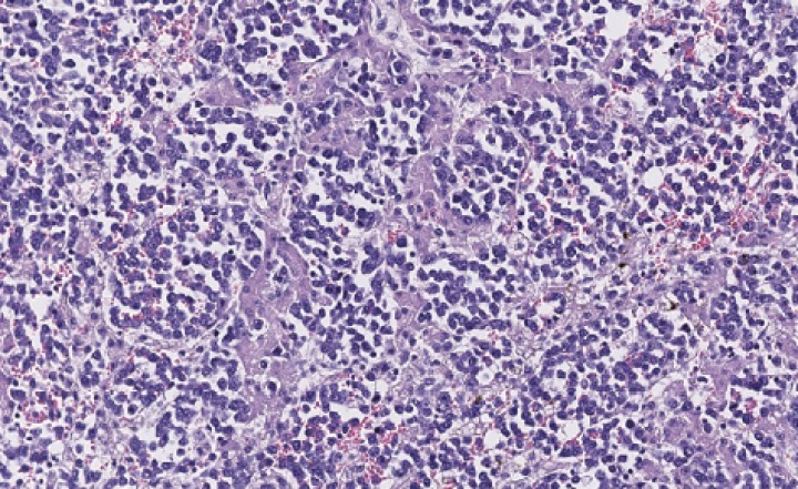 <p>Sinusoides hepáticos distendidos por la presencia circulante de la población neoplásica, con degeneración y pérdida de trabéculas hepatocitarias (x200, tinción H/E).</p>