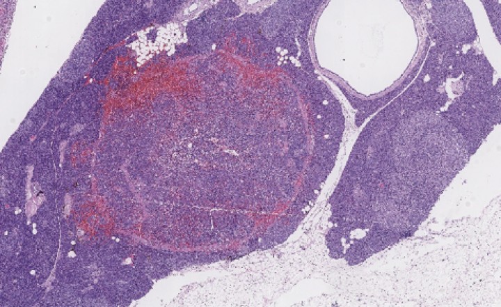 <p>Parénquima pancreático infiltrado y parcialmente reemplazado por la neoplasia (x100, tinción H/E).</p>