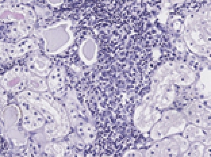 <p>Infiltración intersticial renal por la misma población neoplásica (x200, tinción H/E).</p>
