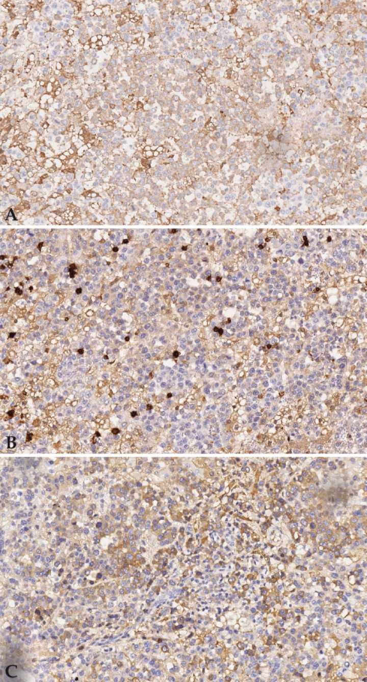 <p>Estudio inmunohistoquímico. (<strong>A</strong>) Positividad débil de la célula neoplásica para marcador CD79 (x200, tinción inmunohistoquímica CD79). (<strong>B</strong>) Las células neoplásicas son negativas para CD3. Se observan escasos linfocitos CD3 positivos (x200, tinción inmunohistoquímica CD3). (<strong>C</strong>) Positividad citoplasmática de la célula neoplásica para marcador CD138 (x200, tinción inmunohistoquímica CD138).</p>