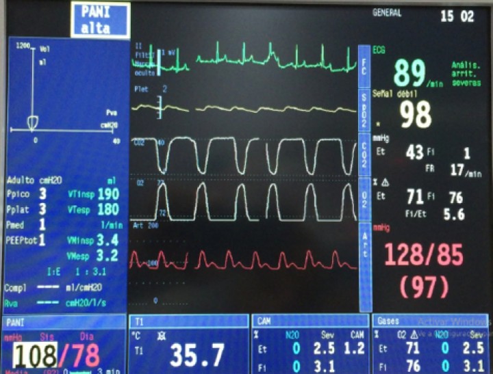 <p>Monitorización anestésica obtenida tras la infusión continua de noradrenalina.</p>