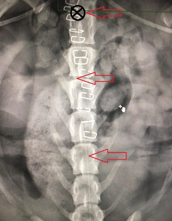 <p>Imagen radiológica en la que se identifica el catéter epidural (flechas rojas) y su posición final (cruz negra) en la vértebra L2.</p>