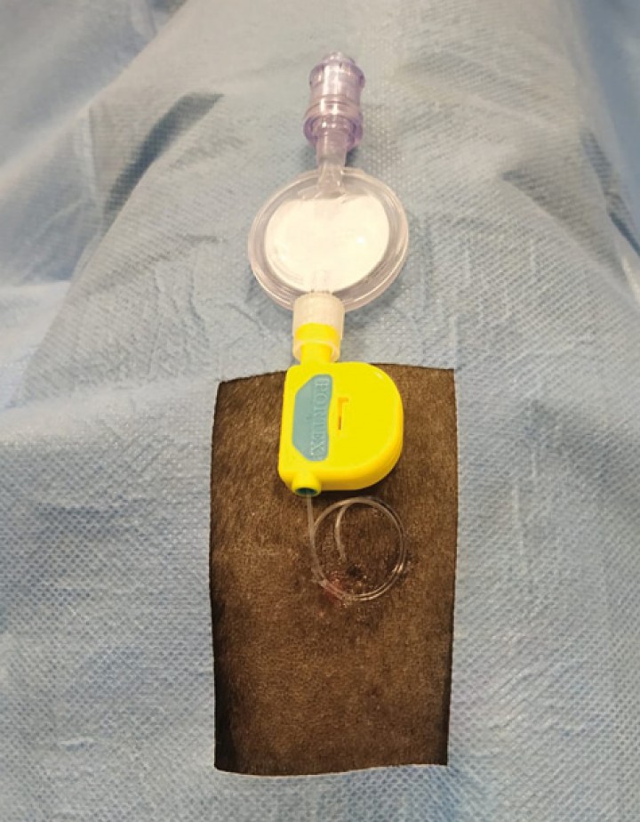 <p>Visualización final de la colocación del catéter epidural y su fijación a la piel.</p>