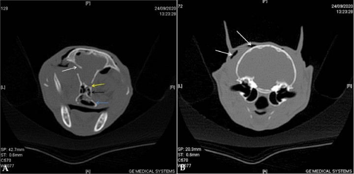 <p>TAC inicial. Cortes transversales en algoritmo de hueso del TAC, adquirido en algoritmo de tejido blando y hueso a 0,6 mm de grosor. (<strong>A</strong>) Corte caudal al seno frontal. Se observa una fractura simple y deprimida en la parte temporal del hueso frontal izquierdo (flecha blanca), desplazamiento de la fosa etmoidal en su unión con el hueso frontal del lado derecho (flecha amarilla), desplazamiento del meato etmoidal y preesfenoides (flecha negra), y fractura simple de la lámina perpendicular derecha del hueso palatino (flecha azul) (<strong>B</strong>) Corte a la altura de las bullas timpánicas que muestra una bóveda craneal íntegra y acúmulo moderado de aire en el tejido subcutáneo de la región temporal izquierda (flechas).</p>