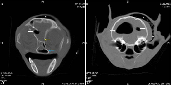 <p>TAC de revisión. Cortes transversales en algoritmo de hueso del TAC de revisión, adquirido en algoritmo de tejido blando y hueso con un grosor de 2 mm. (<strong>A</strong>) Se observa una fractura simple y deprimida en la parte temporal del hueso frontal izquierdo (flecha blanca), desplazamiento de la fosa etmoidal en su unión con el hueso frontal del lado derecho (flecha amarilla), desplazamiento del meato etmoidal y preesfenoides (flecha negra), y fractura simple de la lámina perpendicular derecha del hueso palatino (flecha azul). Además, se aprecia una lesión redonda de bordes bien definidos, hipoatenuante e intracraneal justo en la fractura de la parte temporal del hueso frontal izquierdo (flecha sólida), así como enfisema subcutáneo sobre dicho hueso (asterisco). (<strong>B</strong>) Corte a la altura de las bullas timpánicas en el que se observan dos lesiones intracraneales (con sospecha de ser intraventriculares), redondas, de bordes bien definidos e hipoatenuantes (flechas), con contenido de densidad aire (entre 976 y 1000,05 HU). Además, se observa enfisema subcutáneo a nivel temporal y parietal en el lado derecho (asteriscos).</p>