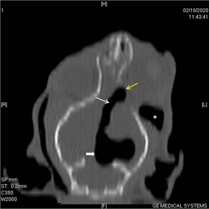 <p>Reformateo dorsal en ventana de hueso en el que se muestra que la lesión intracraneal, hipoatenuante, de márgenes bien definidos y redondeados, de densidad aire (probablemente ventrículo lateral izquierdo) (flecha sólida) comunica con el espacio extradural (flecha amarilla) mediante una fístula (flecha blanca). Además, se observa enfisema en los tejidos blandos del mismo lado (asterisco).</p>
