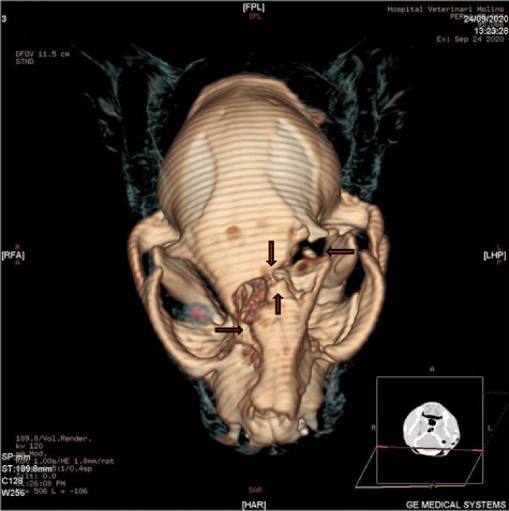 <p>Reformateo 3D, vista dorsal del cráneo que muestra las fracturas a nivel frontal que provocan el desplazamiento en dicha zona (flechas).</p>