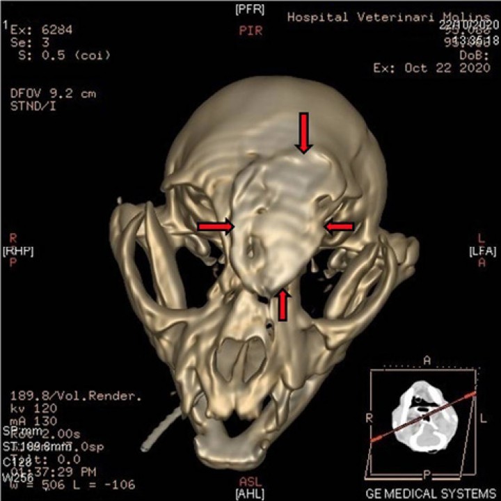 <p>Reformateo 3D, vista frontal postoperatoria en la que se aprecia el sellado del hueso frontal con cemento óseo (flechas).</p>