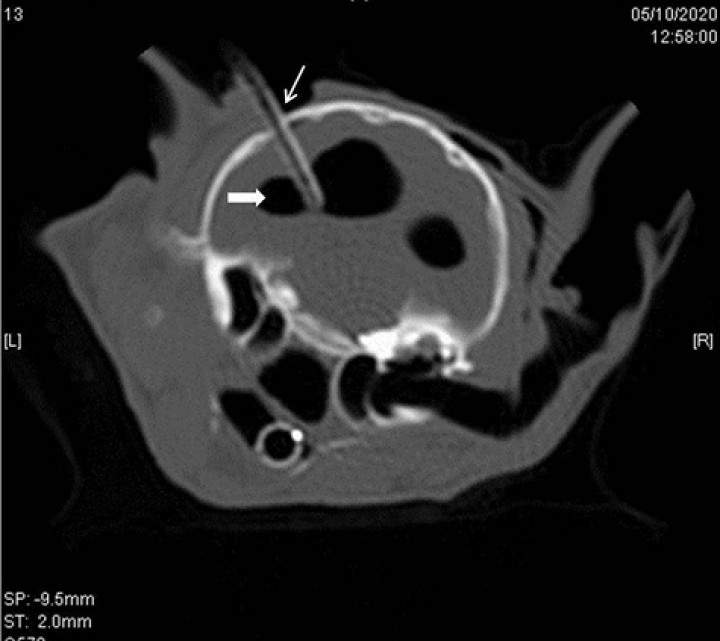 <p>Corte transversal en algoritmo de hueso de 2 mm de grosor a la altura de las bullas timpánicas del TAC postoperatorio en el que se muestra el catéter intraventricular (flecha) en el ventrículo lateral izquierdo, el cual se muestra dilatado, con márgenes bien definidos, redondeado e hipoatenuante (flecha sólida), igual que el ventrículo lateral derecho pero este en menor cantidad.</p>