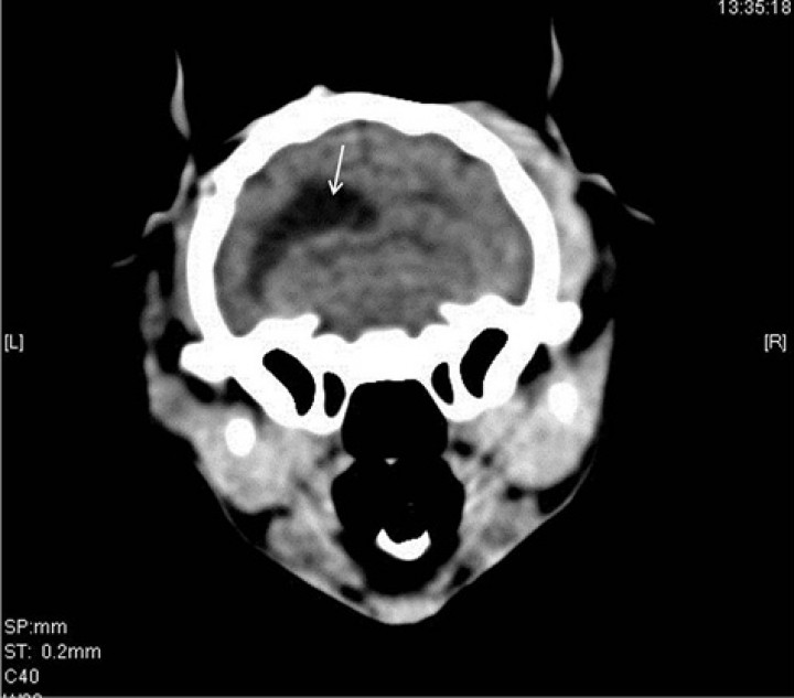 <p>Corte transversal en algoritmo de tejido blando de 2 mm de grosor a la altura de las bullas timpánicas del TAC realizado a los 17 días de la cirugía en el que se observa la resolución del neumoencéfalo. Se observa una dilatación del ventrículo lateral izquierdo (flecha).</p>
