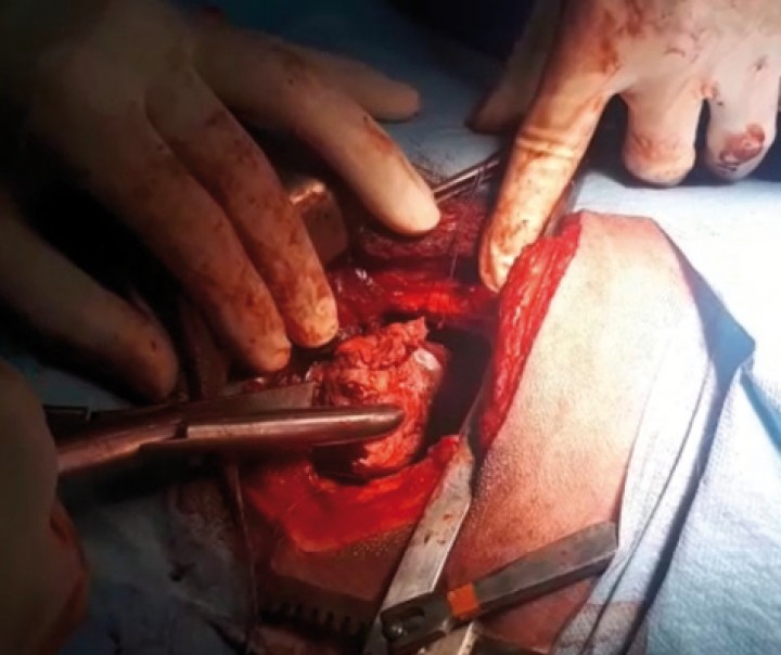 <p>Imagen intraoperatoria del acceso al esófago torácico craneal. Tras la esofagotomía se observa el cuerpo extraño de gran tamaño en el momento de su extracción del interior del esófago.</p>