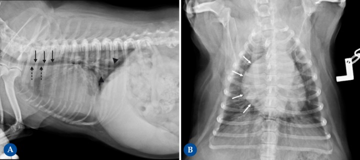 <p> West Highland White Terrier macho castrado de 14 años presentado por tos crónica. En la proyección lateral derecha (Fig. 3A), la silueta cardíaca está aumentada de tamaño, ocupando 4 espacios intercostales (ref<2,5-3), produciendo un desplazamiento dorsal de la tráquea, adquiriendo una posición paralela respecto a la columna vertebral (flechas negras punteadas). El aumento del apoyo esternal en la vista lateral y apariencia de D invertida en la proyección DV de la Fig. 3B (mayor engrosamiento con una forma más redondeada, flechas blancas) son consistentes con cardiomegalia derecha. El cuadrante craneodorsal amplio está causado por dilatación del atrio derecho. Considerando la raza y los cambios en el parénquima pulmonar asociados, con un aumento de la opacidad pulmonar con áreas de patrón alveolointersticial, más marcado en lóbulos caudodorsales (cabezas de flecha) compatibles con posible fibrosis pulmonar, los cambios cardíacos son compatibles con un <em>cor pulmonale</em> por hipertensión pulmonar secundaria a la enfermedad respiratoria, afectando predominantemente al corazón derecho. También se detecta redundancia de la membrana dorsal de la tráquea (flechas negras), sugestivo pero no diagnóstico de colapso de tráquea.</p>