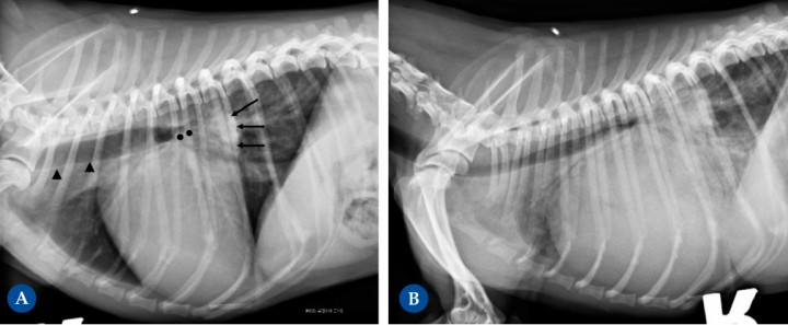 <p>Perro mestizo macho castrado de 12 años presentado para la investigación de soplo cardíaco debido a enfermedad degenerativa de la válvula mitral. La radiografía de la Fig. 4A (proyección lateral derecha) muestra cardiomegalia evidente, con un aumento severo del cuadrante caudodorsal, correspondiente con la dilatación marcada del atrio izquierdo (flechas negras). Esta causa elevación de la tráquea (paralela a la columna vertebral, cabezas de flecha negra) con compresión bronquial (puntos negros) debido al aumento de tamaño del atrio izquierdo. Ambos ventrículos están incrementados de tamaño, resultando en una silueta cardíaca que ocupa aproximadamente 3,5 espacios intercostales (ref<2,5-3). La presencia de leve patrón intersticial dorsocaudal hace sospechar de fases iniciales de insuficiencia cardíaca congestiva izquierda. La radiografía de la Fig. 4B (proyección lateral derecha) corresponde al mismo paciente, mostrando progresión severa de la enfermedad, ahora en fase terminal. Muestra marcada cardiomegalia generalizada, con la silueta cardíaca ocupando unos 4 EIC, con marcado desplazamiento dorsal de la tráquea y con compresión de los bronquios. También se detecta un patrón pulmonar intersticial generalizado con áreas de marcado aumento de la opacidad pulmonar (patrón alveolar), correspondiente a edema pulmonar cardiogénico marcado, signo de insuficiencia cardíaca izquierda.</p>