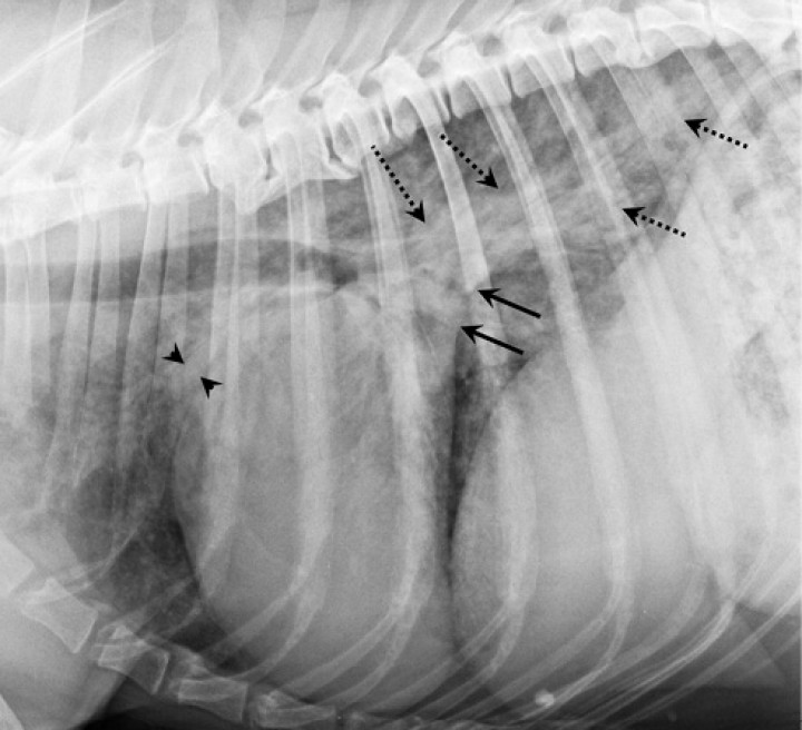 <p>Proyección lateral derecha. Doberman macho castrado de 11 años con cardiomiopatía dilatada. Aumento marcado del tamaño de la silueta cardíaca, ocupando más de dos tercios de la altura del tórax y con elevación de la tráquea. El cuadrante caudodorsal muestra dilatación del atrio izquierdo, que ha pasado a ser convexo en lugar de su forma cóncava habitual (flechas negras). Las venas de los lóbulos craneales aparecen prominentes (cabezas de flecha), presentando un grosor superior al tercio proximal de la 4ª costilla, consistente con la presencia de congestión venosa. Patrón pulmonar intersticial marcado con áreas de patrón alveolar perihiliar y en la región caudodorsal (flechas punteadas) compatible con edema pulmonar de origen cardiogénico.</p>