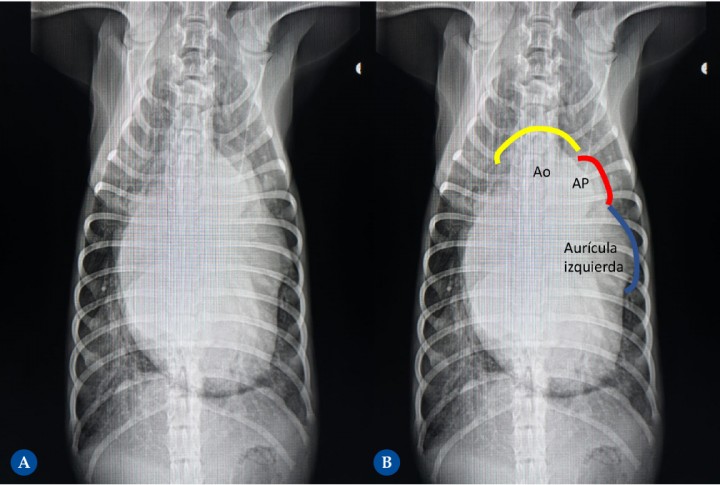 <p>Cachorro de Bretón de 4 meses remitido en fallo cardíaco congestivo debido a la presencia de un conducto arterioso persistente. (<strong>A</strong>) Proyección ventrodorsal. (<strong>B</strong>) Diagrama donde se marca sobre la imagen A las proyecciones anatómicas del "triple knuckle" según la analogía del reloj. Se observa cardiomegalia severa con “triple knuckle” debido a la dilatación marcada del cayado aórtico (de 11 a 1 h), la arteria pulmonar (de 1 a 2) y la orejuela del atrio izquierdo (de 2 a 3). Los bronquios principales caudales están separados entre ellos debido al gran tamaño del cuerpo del atrio izquierdo, dando lo que coloquialmente se llama “las piernas del vaquero”. El ápex izquierdo se ve redondeado y apoyado ampliamente sobre el diafragma, consistente con la presencia de dilatación ventricular izquierda severa. Congestión venosa y patrón pulmonar intersticial generalizado son signos de insuficiencia cardíaca congestiva izquierda. Línea de color amarillo: de 11 h a 1 h. Línea de color rojo: de 1 h a 2 h. Línea de color azul: de 2 h a 3 h. Ao: aorta. AP: arteria pulmonar.</p>