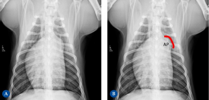 <p>Perro macho castrado de 2,5 años de edad. Se le detecta un soplo de grado I-II. (<strong>A</strong>) Proyección ventrodorsal. (<strong>B</strong>) Diagrama donde se marca sobre la imagen A la proyección anatómica de la arteria pulmonar (AP) . En la radiografía se visualiza un abultamiento (“knuckle”) en el área de proyección anatómica del tronco de la arteria pulmonar (línea roja), según la analogía del reloj entre la 1 h y las 2 h. Dicho paciente fue diagnosticado mediante estudio ecocardiográfico de estenosis pulmonar valvular, con gradiente de estenosis moderada. Este engrosamiento que se observa es debido a la dilatación post-estenótica.</p>
