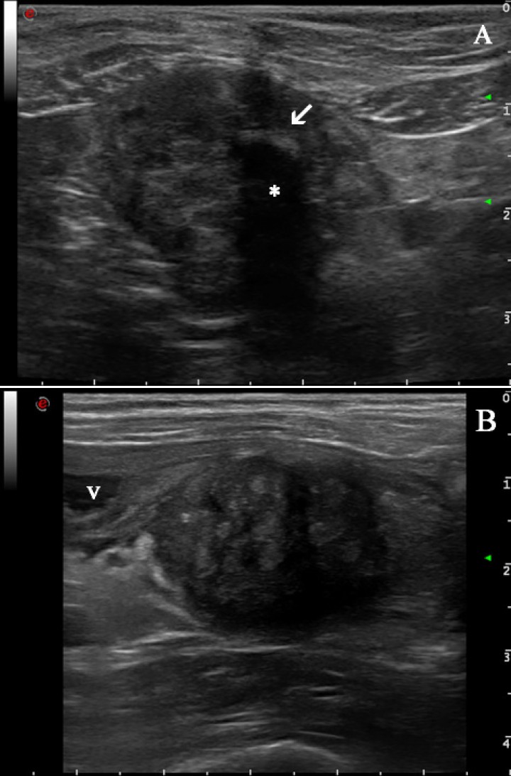 <p>Imágenes ecográficas de la masa en diferentes momentos de presentación. (<strong>A</strong>) Día de la presentación: Masa redondeada, bien definida de ecotextura heterogénea y ecogenicidad mixta caudal a la vejiga de la orina y en cuyo interior se visualiza una estructura hiperecogénica (flecha blanca) que proyecta sombra acústica (asterisco). (<strong>B</strong>) Imagen obtenida un año más tarde donde se observa una masa de similares características a la figura 1A. v: vejiga de la orina.</p>
