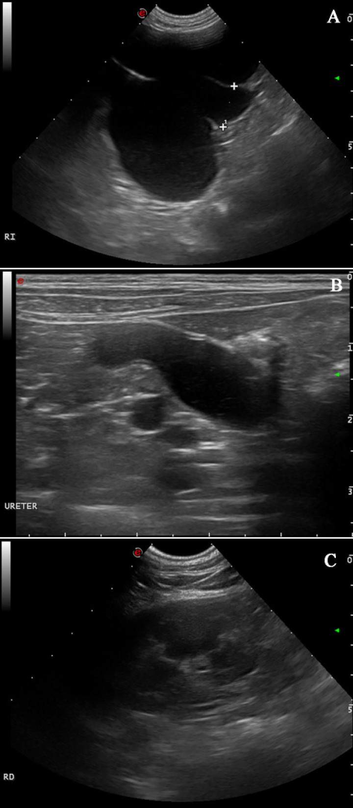 <p>Imágenes ecográficas al año de la primera presentación. (<strong>A</strong>) Hidronefrosis del riñón izquierdo: se observa una marcada dilatación de la pelvis renal y divertículos del riñón izquierdo por líquido anecogénico con una mínima remanencia de la corteza renal. (<strong>B</strong>) Severo hidrouréter izquierdo con contenido líquido anecogénico. (<strong>C</strong>) Riñón derecho de aspecto normal.</p>