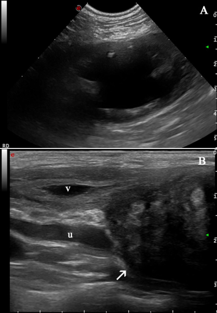 <p>Imágenes ecográficas a los tres meses de la segunda presentación. (<strong>A</strong>) Hidronefrosis del riñón derecho: se observa una marcada dilatación de la pelvis renal y divertículos del riñón derecho por líquido anecogénico con una mínima remanencia de la corteza renal. (<strong>B</strong>) El uréter derecho (u) dorsal a la vejiga de la orina (v) e involucrado con la masa (flecha blanca) se visualiza dilatado (hidrouréter).</p>