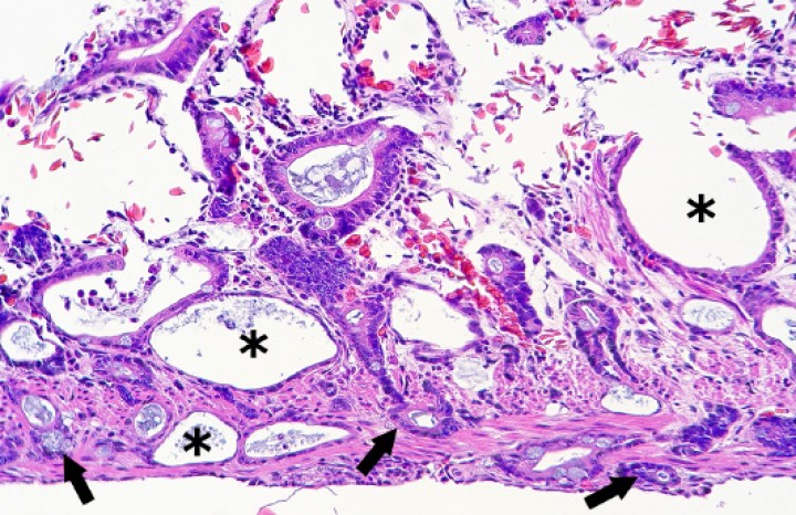 <p>Intestino delgado; rana dardo verdinegra (<em>Dendrobates auratus</em>). Proliferación neoplásica de epitelio entérico, que invade todas las capas (flechas) y forma estructuras glandulares variablemente dilatadas (asteriscos). Hematoxilina-eosina, x240.</p>