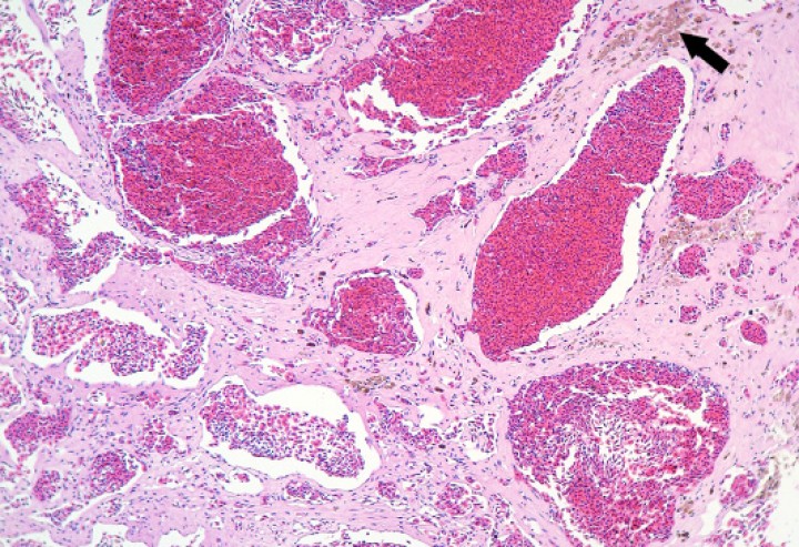 <p>Pulmón; sapo buey (<em>Rhinella schneideri</em>). Se aprecia una proliferación neoplásica de cavernas vasculares revestidas por endotelio bien diferenciado (hemangioma) con focos de hemosiderosis (flecha) en el estroma de soporte de la neoplasia. Hematoxilina-eosina, x110.</p>