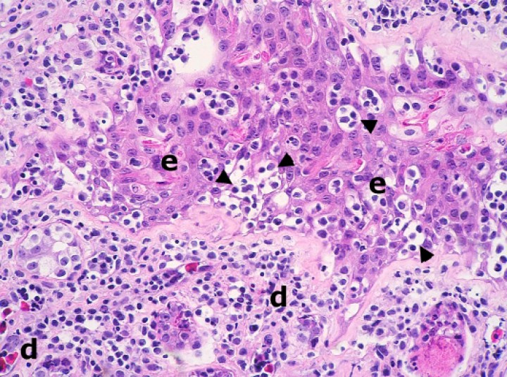 <p>Piel; rana tomate (<em>Dyscophus guineti</em>). Con patrón difuso, la dermis (d) está densamente infiltrada por linfocitos pequeños neoplásicos acompañados por detritos nucleares; estos infiltrados forman además numerosos focos de epiteliotropismo caracterizados por la presencia de múltiples linfocitos dispuestos en pequeños nidos intraepidérmicos (cabezas de flecha). e: epidermis. Hematoxilina-eosina, x220.</p>