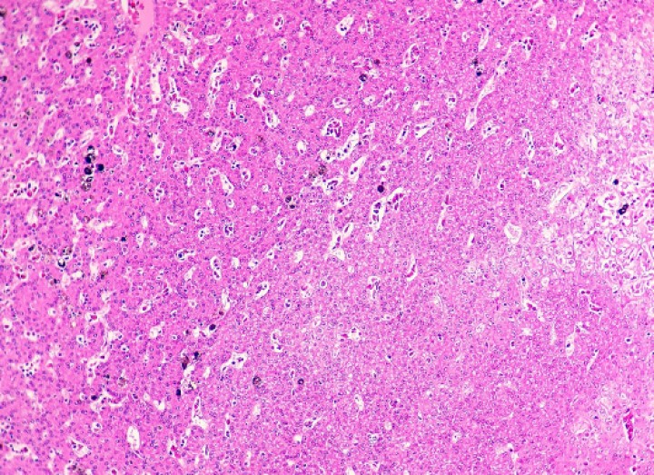 <p>Hígado; sapillo balear (<em>Alytes muletensis</em>). Imagen histológica de un hepatoma, en la que se observa proliferación neoplásica uniforme de hepatocitos bien diferenciados y ausencia de áreas porta. Hematoxilina-eosina, x120.</p>