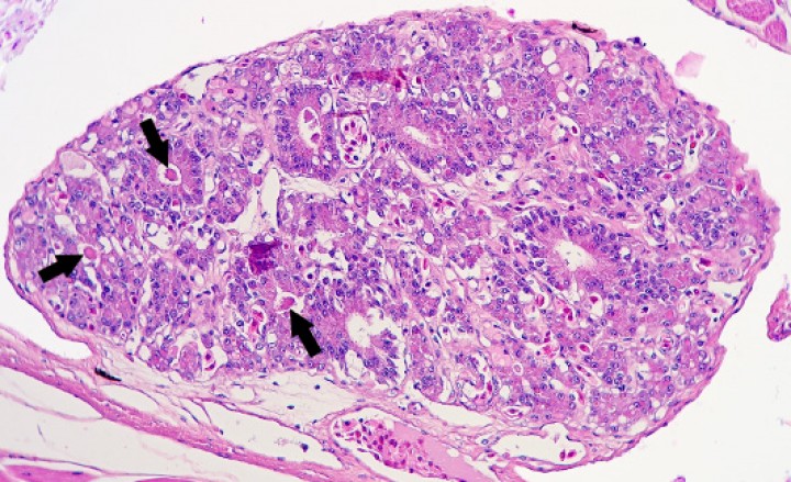 <p>Tiroides; rana tomate (<em>Dyscophus guineti</em>). Con patrón difuso, los folículos carecen casi completamente de coloide (las flechas indican el coloide escaso restante) y están revestidos por epitelio cilíndrico alto (bocio hiperplásico). Hematoxilina-eosina, x240.</p>