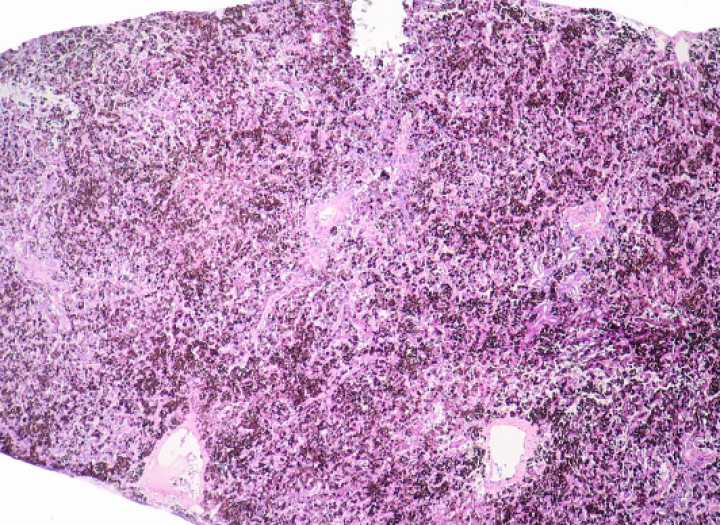 <p>Hígado; rana tomate (<em>Dyscophus guineti</em>). Se aprecia melanosis difusa intensa (correspondiente al pigmento oscuro depositado de forma uniforme y en cantidad alta en todo el parénquima). Hematoxilina-eosina, x44.</p>