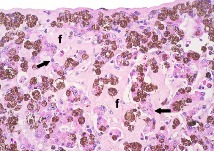 <p>Hígado; rana tomate (<em>Dyscophus guineti)</em>. El tejido hepatocelular está parcialmente reemplazado por melanomacrófagos y fibrosis (f); los cordones de hepatocitos con frecuencia están atróficos (flechas) y también contienen melanina. Hematoxilina-eosina, x440.</p>
