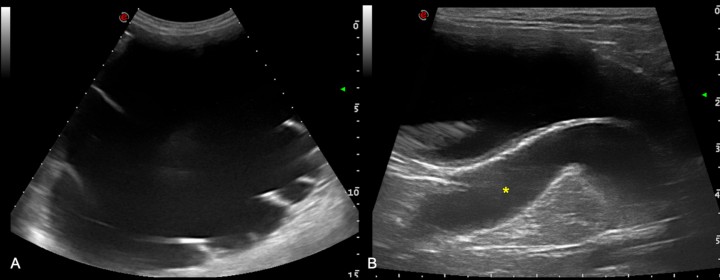 <p>Imágenes ecográficas. (<strong>A</strong>) Hidronefrosis en riñón derecho con resto de cortical. (<strong>B</strong>) Dilatación grave del uréter derecho hacia su desembocadura en la uretra prostática (asterisco amarillo).</p>