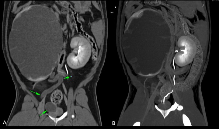 <p>Imágenes tomográficas. (<strong>A</strong>) Corte dorsal del trayecto tortuoso del uréter derecho sin contraste (flechas verdes). (<strong>B</strong>) Corte dorsal del trayecto y desembocadura en la uretra prostática del uréter izquierdo.</p>