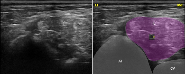<p>Imagen ecográfica del nervio femoral a su paso por el músculo iliopsoas. Músculo iliopsoas (IL), apófisis transversa de L6 (AT), cuerpo vertebral de L6 (CV), nervio femoral (F). Lt: Lateral, Md: Medial.</p>