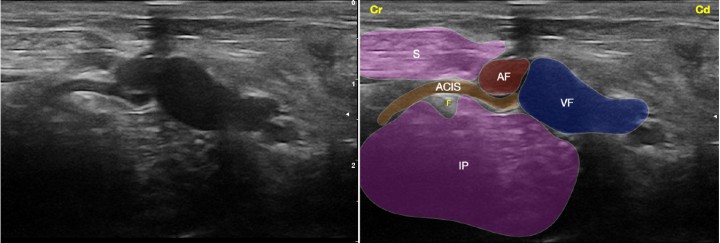 <p>Imagen ecográfica del nervio femoral a su paso por el canal femoral. Músculo sartorio (S), músculo iliopsoas (IP), arteria femoral (AF), arteria circunfleja ilíaca superficial (ACIS), vena femoral (VF), nervio femoral (F). Cr: Craneal, Cd: Caudal.</p>