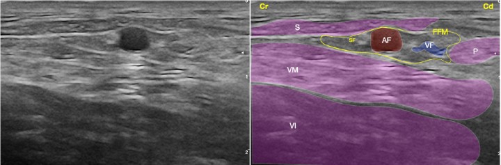 <p>Imagen ecográfica del nervio safeno (rama sensitiva distal del nervio femoral) a nivel del fémur medio. Músculo sartorio (S), músculo vasto medial (componente del cuádriceps) (VM), músculo vasto intermedio (componente del cuádriceps) (VI), músculo pectíneo (P), fascia femoral media (FFM), arteria femoral (AF), vena femoral (VF), nervio safeno (SF). Cr: Craneal, Cd: Caudal.</p>