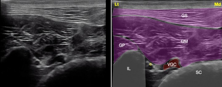 <p>Imagen ecográfica del plexo sacro a nivel de la escotadura ciática mayor. Músculo glúteo superficial (GS), músculo glúteo medio (GM), músculo glúteo profundo (GP), ilion (IL), sacro (SC), nervio ciático (C), vasos glúteos caudales (VGC). Lt: Lateral, Md: Medial.</p>