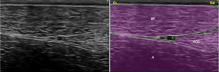 <p>Imagen ecográfica del nervio ciático a nivel del fémur medio. Músculo bíceps femoral (BF), músculo aductor (A), músculo aductor crural caudal (ACC), nervio ciático integrado por sus dos componentes: nervio peroneo común (PC) y nervio tibial (T). Cr: Craneal, Cd: Caudal.</p>