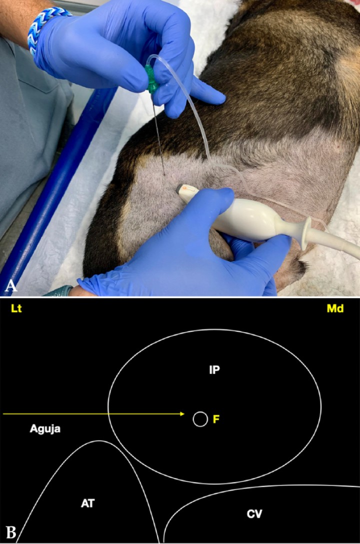 <p>(<strong>A</strong>) Posición del transductor y la aguja para el abordaje en plano del nervio femoral a su paso por el músculo iliopsoas. (<strong>B</strong>) Imagen esquemática de las estructuras anatómicas y la aguja. Músculo iliopsoas (IP), apófisis transversa de L6 (AT), cuerpo vertebral de L6 (CV), nervio femoral (F). Lt: Lateral, Md: Medial.</p>