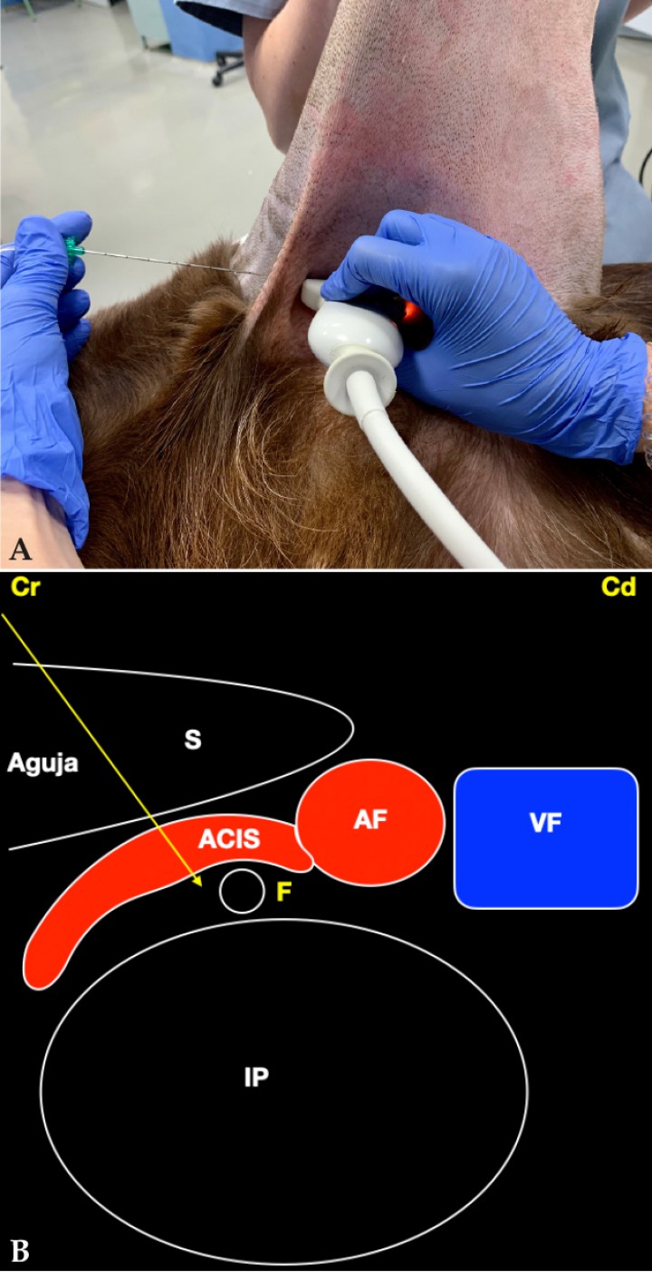 <p>(<strong>A</strong>) Posición del transductor y la aguja para el abordaje en plano del nervio femoral a su paso por el canal femoral. (<strong>B</strong>) Imagen esquemática de las estructuras anatómicas y la aguja. Nótese que se debe modificar la posición del transductor una vez localizado el nervio para evitar la arteria circunfleja ilíaca superficial en el abordaje al nervio. Músculo sartorio (S), músculo iliopsoas (IP), arteria femoral (AF), arteria circunfleja ilíaca superficial (ACIS), vena femoral (VF), nervio femoral (F). Cr: Craneal, Cd: Caudal.</p>