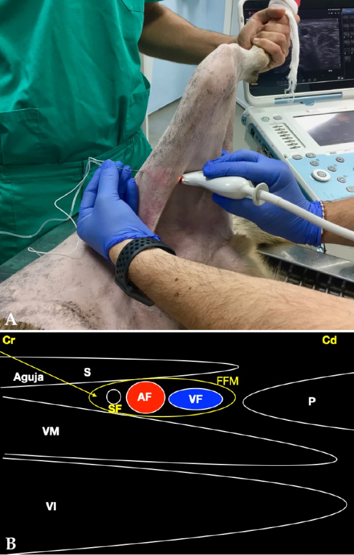 <p>(<strong>A</strong>) Posición del transductor y la aguja para el abordaje en plano del nervio safeno (rama sensitiva distal del nervio femoral) a nivel del fémur medio. (<strong>B</strong>) Imagen esquemática de las estructuras anatómicas y la aguja. Músculo sartorio (S), músculo vasto medial (componente del cuádriceps) (VM), músculo vasto intermedio (componente del cuádriceps) (VI), músculo pectíneo (P), fascia femoral media (FFM), arteria femoral (AF), vena femoral (VF), nervio safeno (SF). Cr: Craneal, Cd: Caudal.</p>