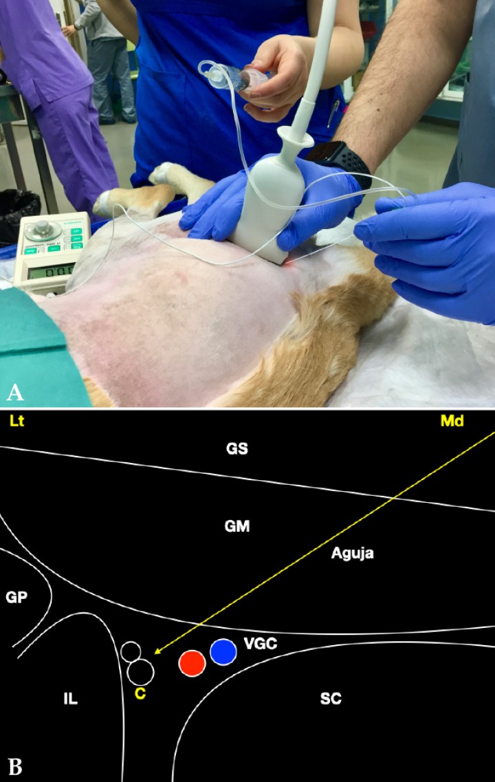 <p>(<strong>A</strong>) Posición del transductor y la aguja para el abordaje en plano del plexo sacro a nivel de la escotadura ciática mayor. (<strong>B</strong>) Imagen esquemática de las estructuras anatómicas y la aguja. Músculo glúteo superficial (GS), músculo glúteo medio (GM), músculo glúteo profundo (GP), ilion (IL), sacro (SC), nervio ciático (C), vasos glúteos caudales (VGC). Lt: Lateral, Md: Medial.</p>