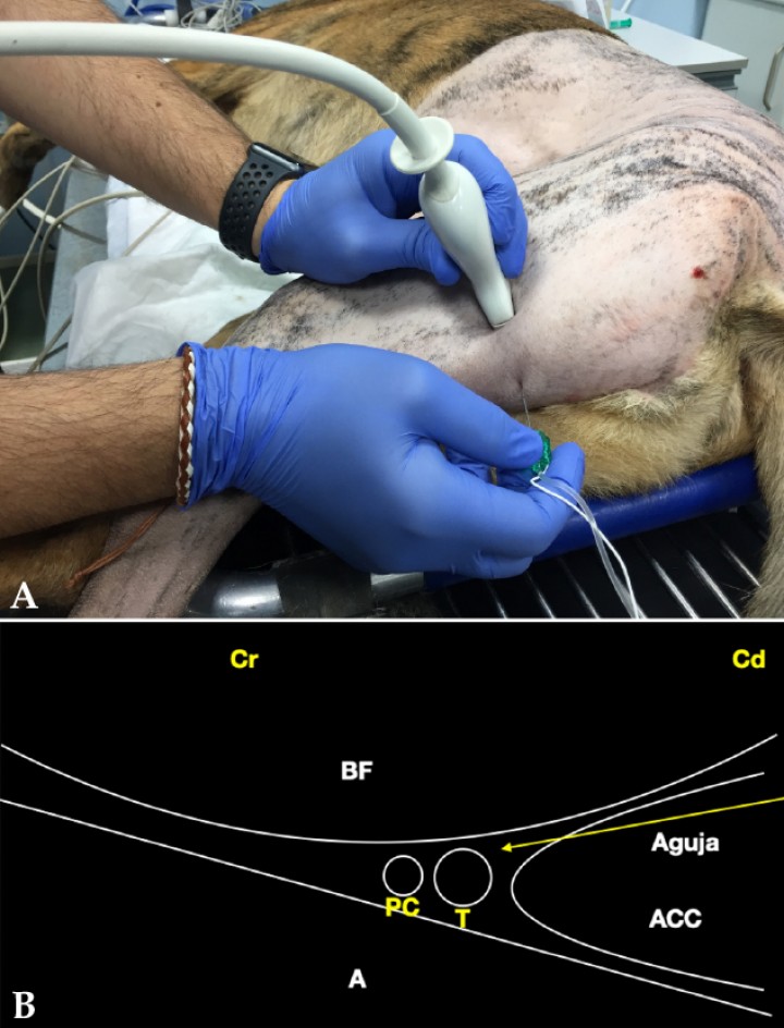 <p>(<strong>A</strong>) Posición del transductor y la aguja para el abordaje en plano del nervio ciático a nivel del fémur medio. (<strong>B</strong>) Imagen esquemática de las estructuras anatómicas y la aguja. Músculo bíceps femoral (BF), músculo aductor (A), músculo aductor crural caudal (ACC), nervio ciático integrado por sus dos componentes: nervio peroneo común (PC) y nervio tibial (T). Cr: Craneal, Cd: Caudal.</p>