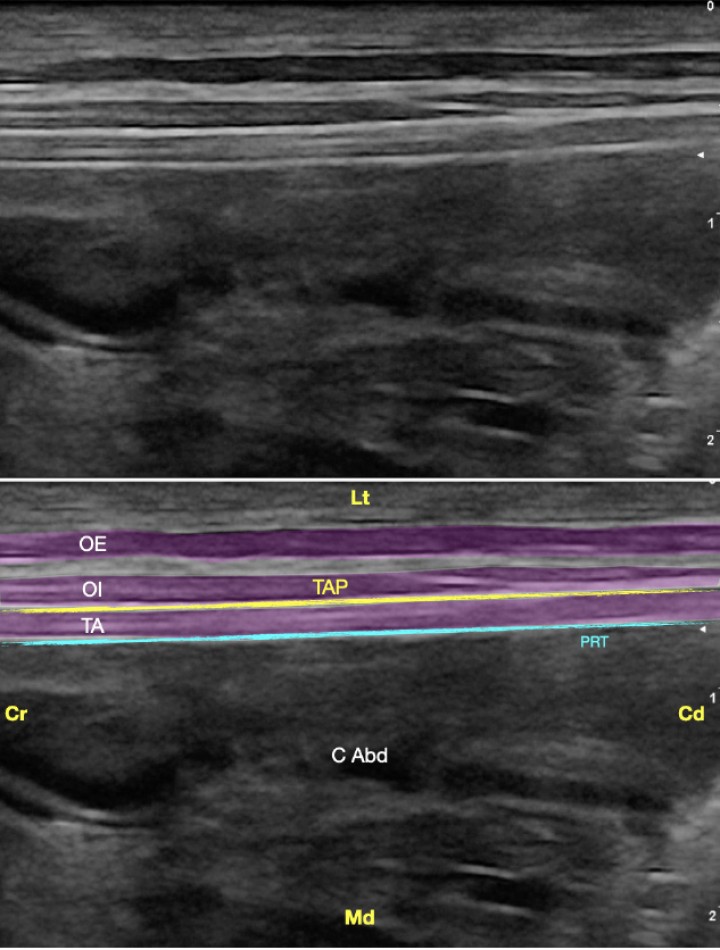 <p>Imagen ecográfica del plano transverso abdominal lateral. Músculo oblicuo externo (OE), músculo oblicuo interno (OI), músculo transverso abdominal (TA), plano del transverso abdominal (TAP), peritoneo (PRT), cavidad abdominal (C Abd). Cr: Craneal, Cd: Caudal, Lt: Lateral, Md: Medial.</p>