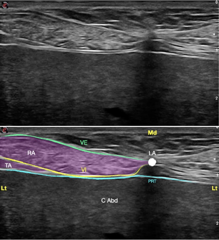 <p>Imagen ecográfica de la vaina del recto del abdomen. Músculo recto del abdomen (RA), músculo transverso abdominal (TA), vaina externa (VE), vaina interna (VI), línea alba (LA), peritoneo (PRT), cavidad abdominal (C Abd). Lt: Lateral, Md: Medial.</p>