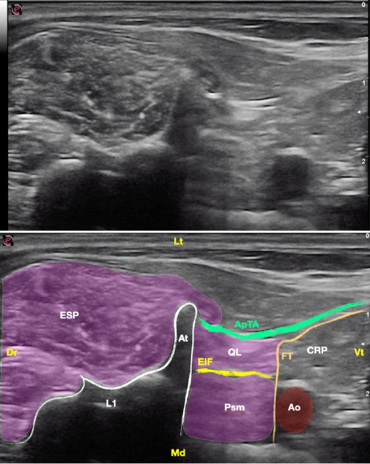 <p>Imagen ecográfica del músculo cuadrado lumbar. Músculo cuadrado lumbar (QL), músculo psoas menor (Psm), espacio interfascial (EIF), aponeurosis de inserción del músculo transverso abdominal (ApTA), fascia transversalis (FT), cavidad retroperitoneal (CRP), arteria aorta (Ao), grupo del erector espinal (ESP), vértebra L1 (L1), apófisis transversa (At). Dr: Dorsal, Vt: Ventral, Lt: Lateral, Md: Medial.</p>