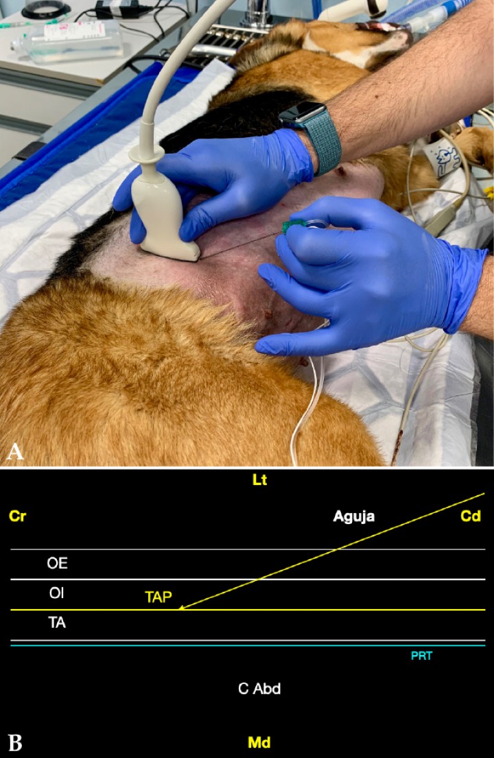 <p>(<strong>A</strong>) Posición del transductor y la aguja para el abordaje en plano del plano del transverso abdominal lateral. (<strong>B</strong>) Imagen esquemática de las estructuras anatómicas y la aguja. Músculo oblicuo externo (OE), músculo oblicuo interno (OI), músculo transverso abdominal (TA), plano del transverso abdominal (TAP), peritoneo (PRT), cavidad abdominal (C Abd). Cr: Craneal, Cd: Caudal, Lt: Lateral, Md: Medial.</p>